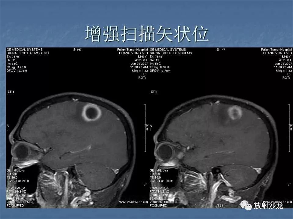 【病例】右顶叶炎性肉芽肿1例MR