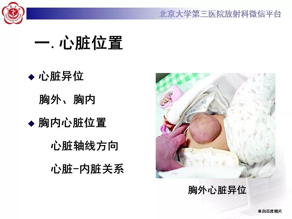 【病例】先天性心脏病诊断思路与基本征象