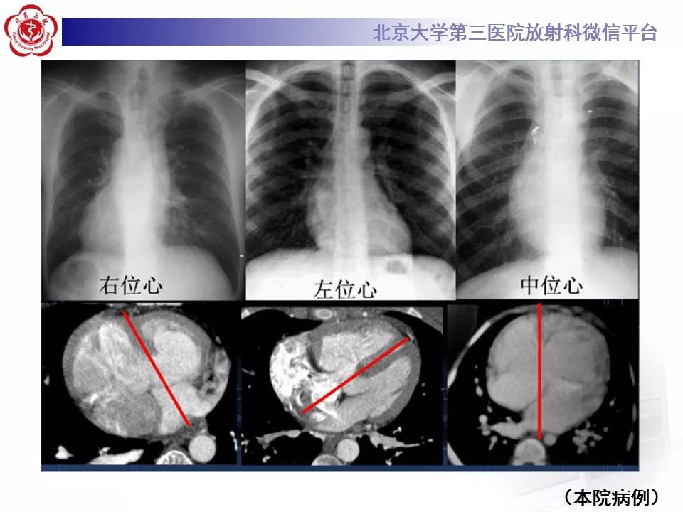 【病例】先天性心脏病诊断思路与基本征象