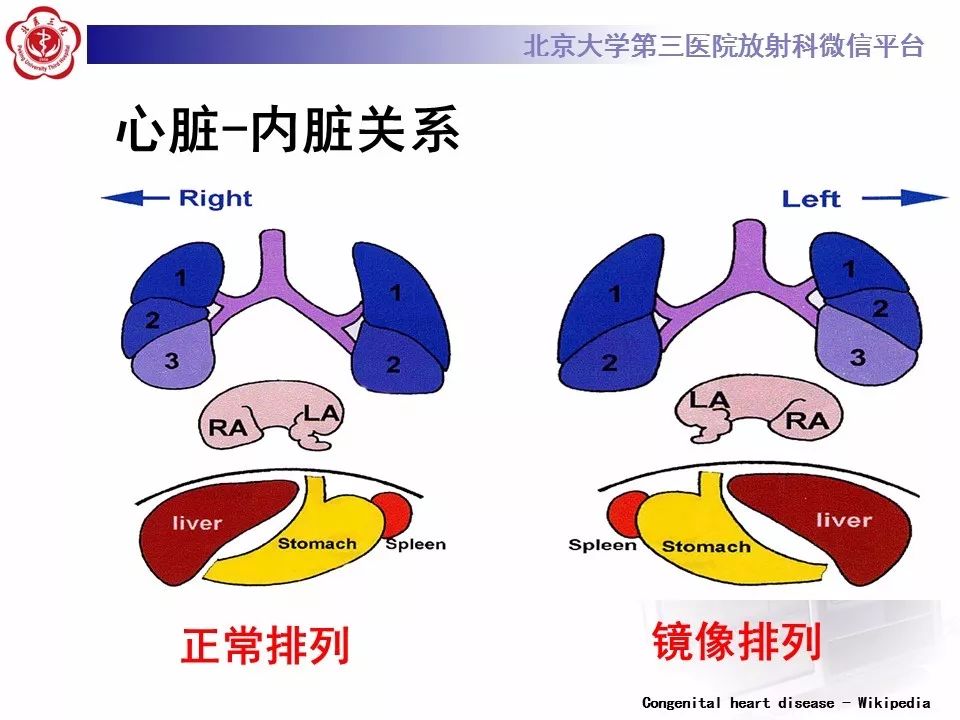 【病例】先天性心脏病诊断思路与基本征象