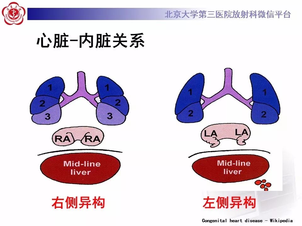 【病例】先天性心脏病诊断思路与基本征象