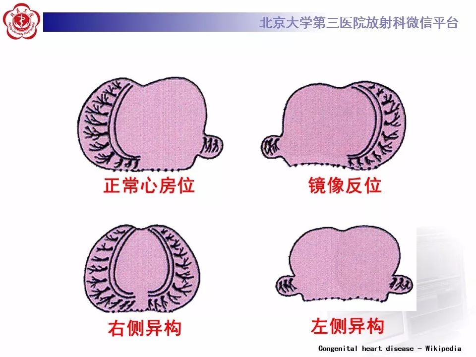 【病例】先天性心脏病诊断思路与基本征象