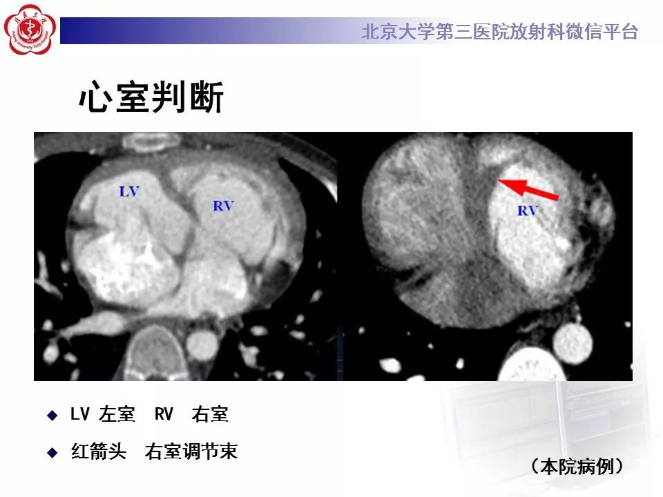 【病例】先天性心脏病诊断思路与基本征象