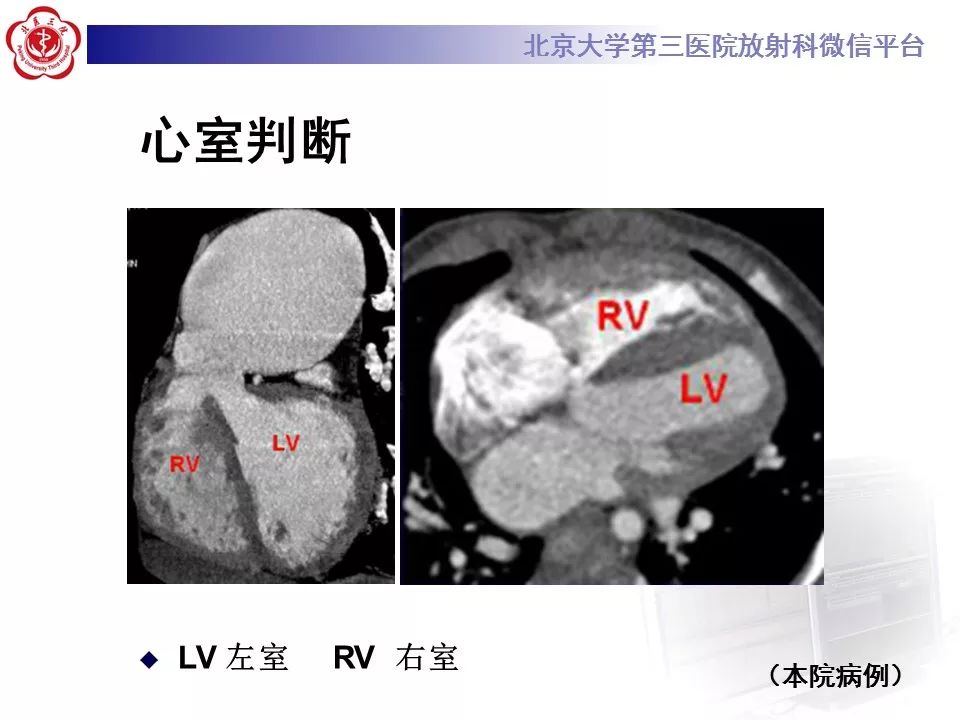 【病例】先天性心脏病诊断思路与基本征象