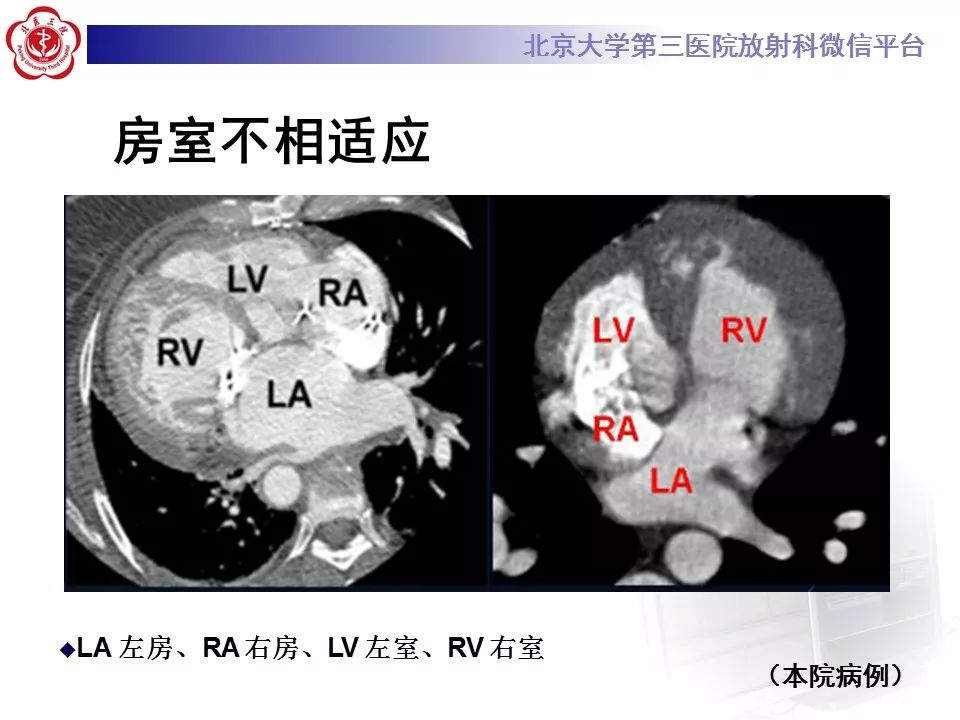 【病例】先天性心脏病诊断思路与基本征象