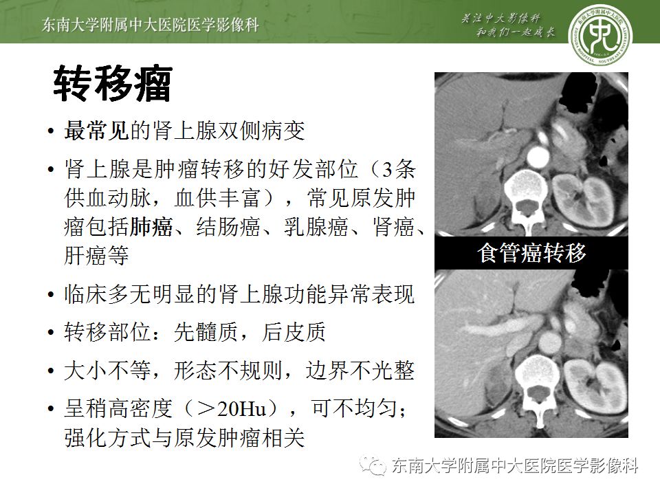 【病例】双侧肾上腺淋巴瘤1例CT影像表现