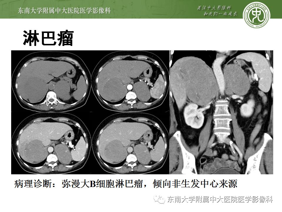 【病例】双侧肾上腺淋巴瘤1例CT影像表现