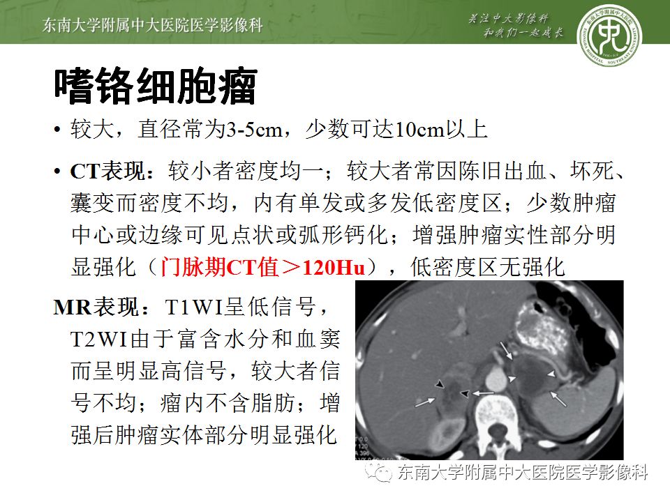 【病例】双侧肾上腺淋巴瘤1例CT影像表现