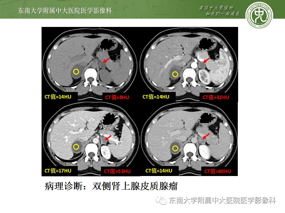 【病例】双侧肾上腺淋巴瘤1例CT影像表现