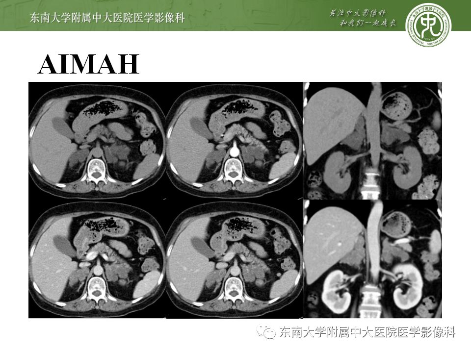 【病例】双侧肾上腺淋巴瘤1例CT影像表现
