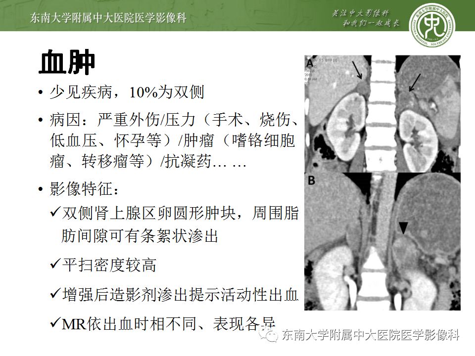 【病例】双侧肾上腺淋巴瘤1例CT影像表现