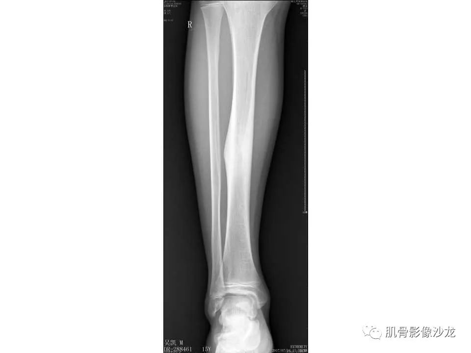 【病例】胫骨骨性纤维结构不良/骨化性纤维瘤1例X线CT及MR