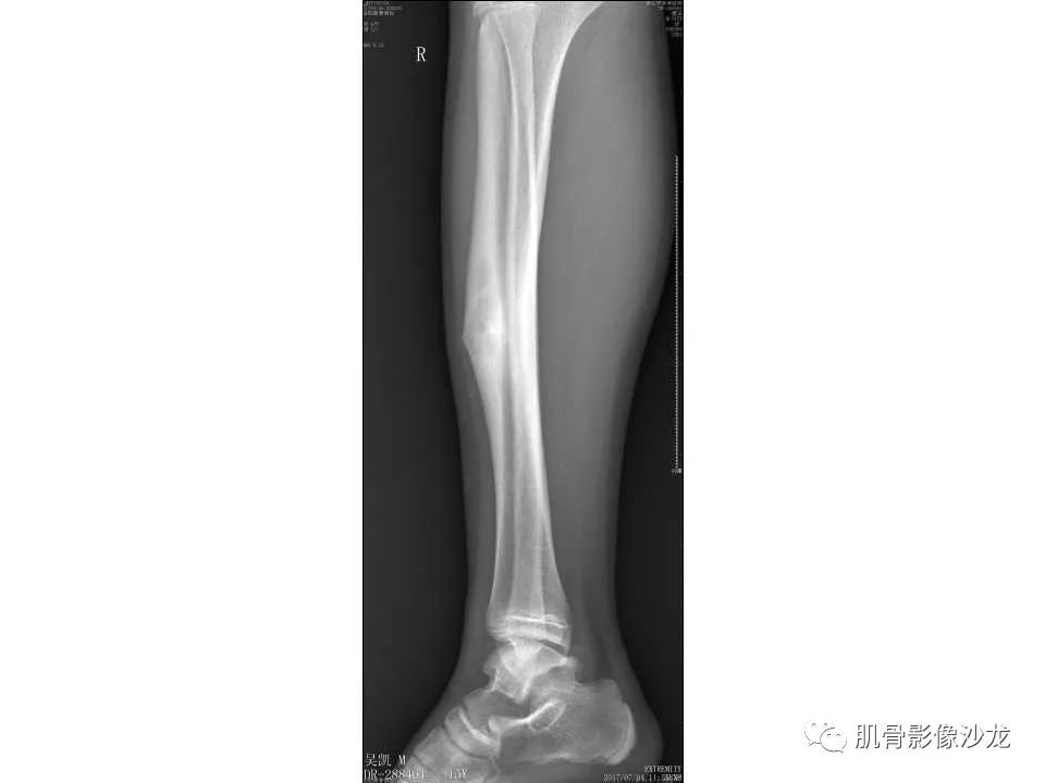 【病例】胫骨骨性纤维结构不良/骨化性纤维瘤1例X线CT及MR 【病例】胫骨骨性纤维结构不良/骨化性纤维瘤1例X线CT及MR