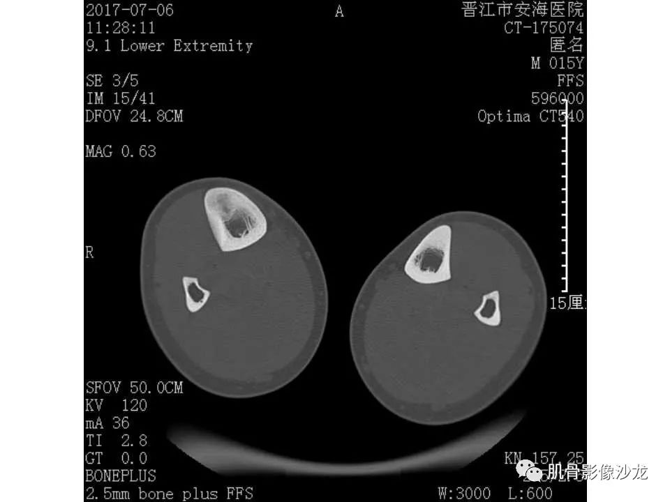 【病例】胫骨骨性纤维结构不良/骨化性纤维瘤1例X线CT及MR 【病例】胫骨骨性纤维结构不良/骨化性纤维瘤1例X线CT及MR