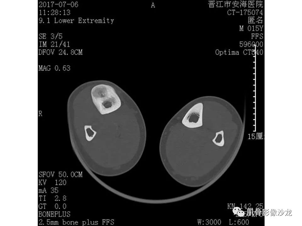 【病例】胫骨骨性纤维结构不良/骨化性纤维瘤1例X线CT及MR 【病例】胫骨骨性纤维结构不良/骨化性纤维瘤1例X线CT及MR