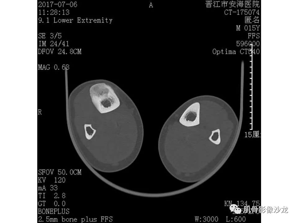 【病例】胫骨骨性纤维结构不良/骨化性纤维瘤1例X线CT及MR 【病例】胫骨骨性纤维结构不良/骨化性纤维瘤1例X线CT及MR