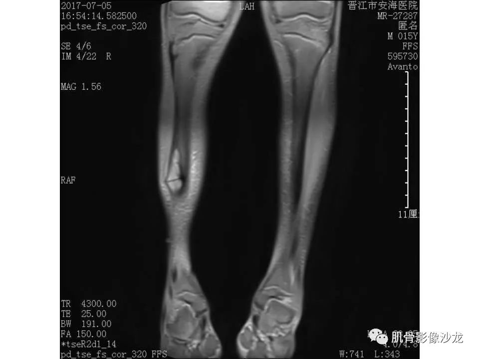 【病例】胫骨骨性纤维结构不良/骨化性纤维瘤1例X线CT及MR 【病例】胫骨骨性纤维结构不良/骨化性纤维瘤1例X线CT及MR