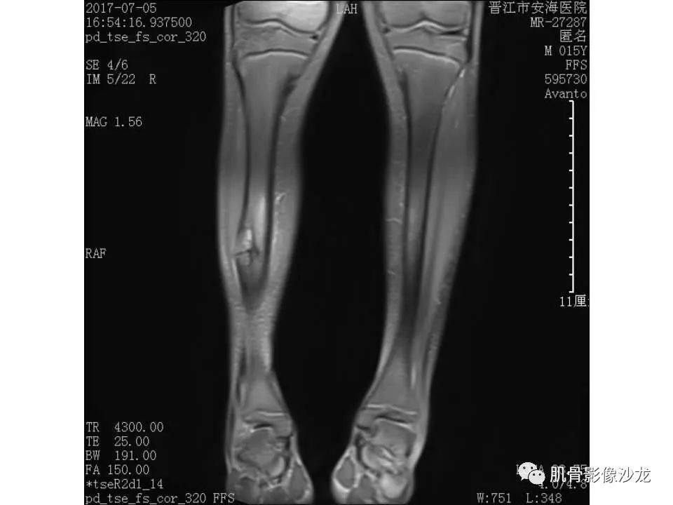 【病例】胫骨骨性纤维结构不良/骨化性纤维瘤1例X线CT及MR 【病例】胫骨骨性纤维结构不良/骨化性纤维瘤1例X线CT及MR