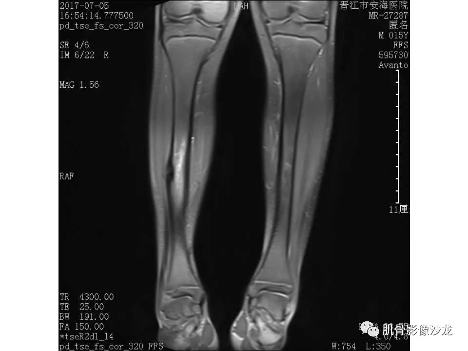 【病例】胫骨骨性纤维结构不良/骨化性纤维瘤1例X线CT及MR 【病例】胫骨骨性纤维结构不良/骨化性纤维瘤1例X线CT及MR