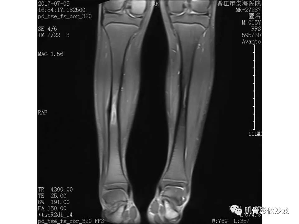 【病例】胫骨骨性纤维结构不良/骨化性纤维瘤1例X线CT及MR 【病例】胫骨骨性纤维结构不良/骨化性纤维瘤1例X线CT及MR