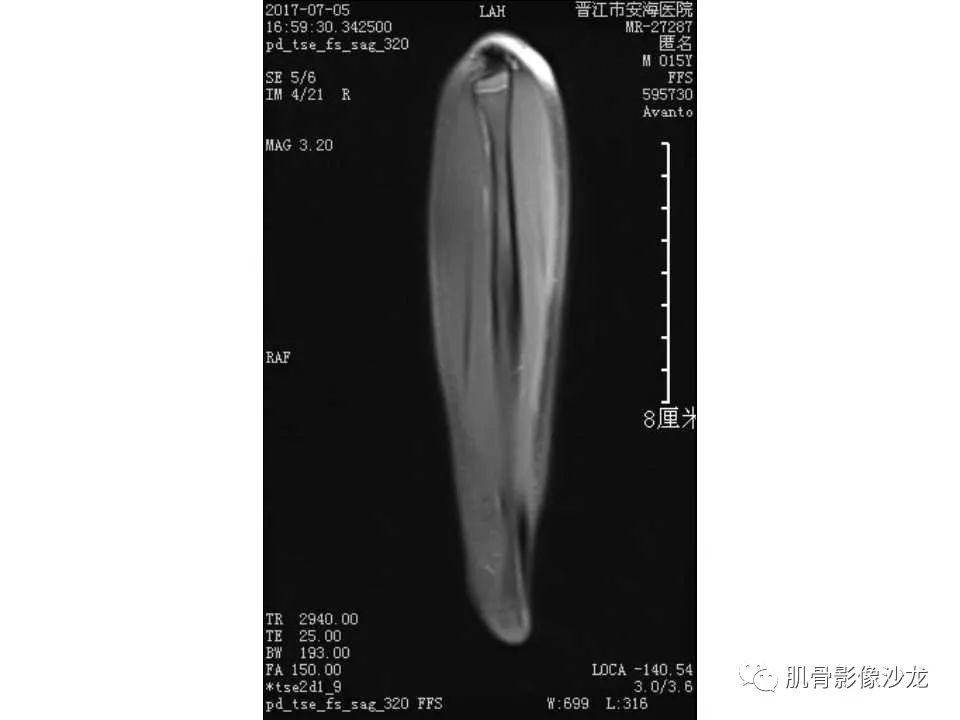 【病例】胫骨骨性纤维结构不良/骨化性纤维瘤1例X线CT及MR 【病例】胫骨骨性纤维结构不良/骨化性纤维瘤1例X线CT及MR