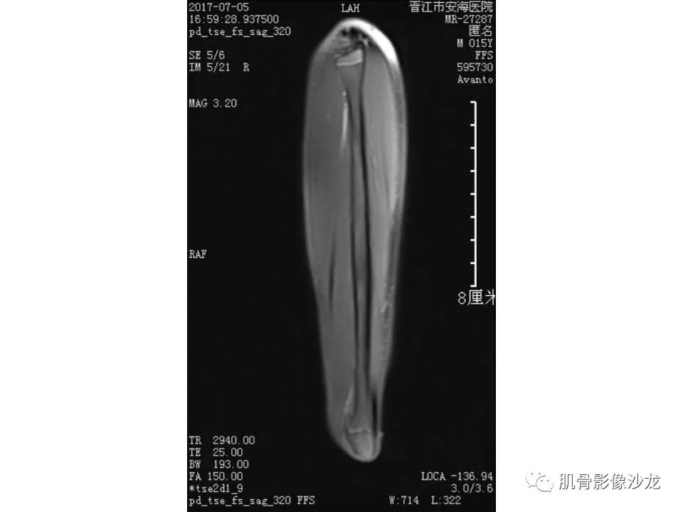 【病例】胫骨骨性纤维结构不良/骨化性纤维瘤1例X线CT及MR 【病例】胫骨骨性纤维结构不良/骨化性纤维瘤1例X线CT及MR