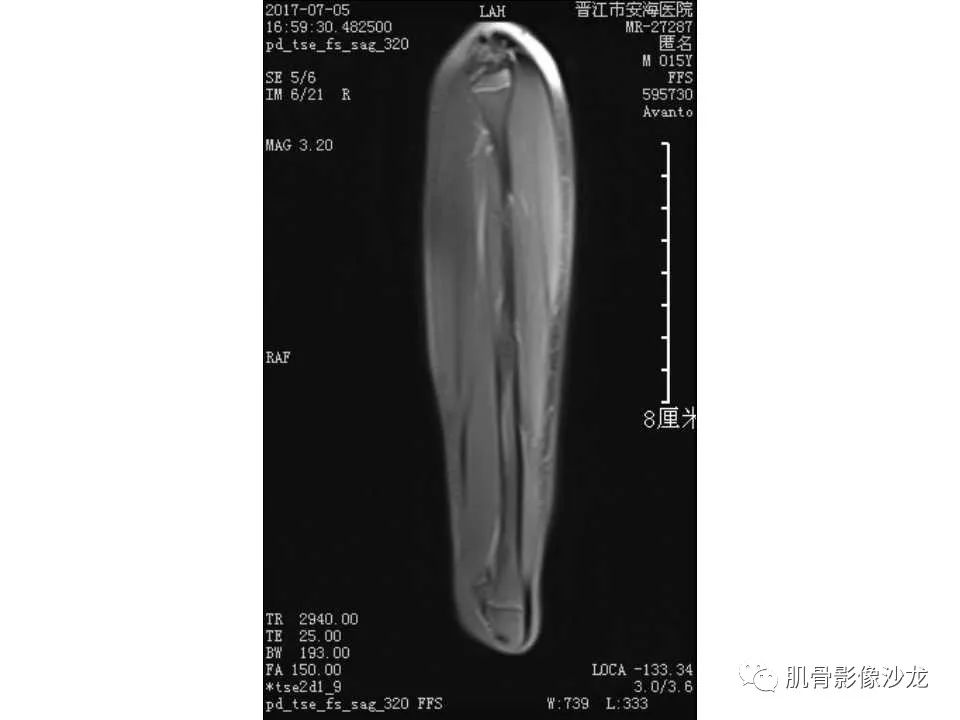 【病例】胫骨骨性纤维结构不良/骨化性纤维瘤1例X线CT及MR 【病例】胫骨骨性纤维结构不良/骨化性纤维瘤1例X线CT及MR