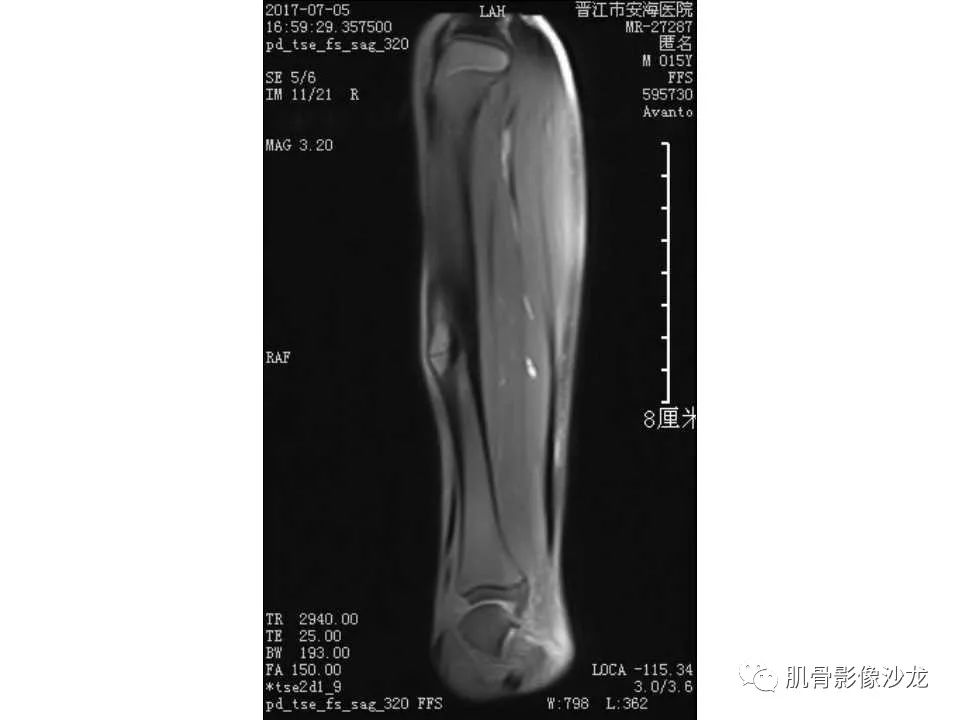 【病例】胫骨骨性纤维结构不良/骨化性纤维瘤1例X线CT及MR 【病例】胫骨骨性纤维结构不良/骨化性纤维瘤1例X线CT及MR