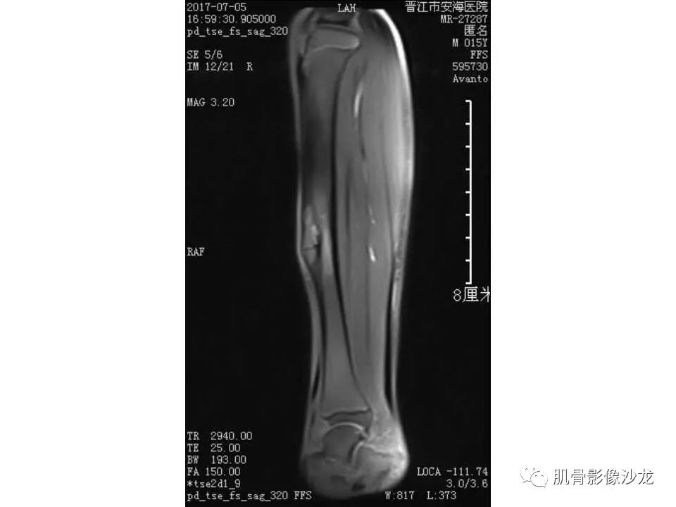 【病例】胫骨骨性纤维结构不良/骨化性纤维瘤1例X线CT及MR 【病例】胫骨骨性纤维结构不良/骨化性纤维瘤1例X线CT及MR