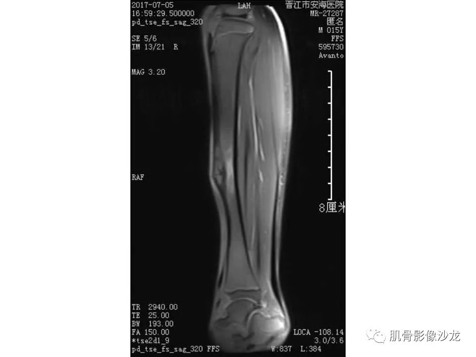 【病例】胫骨骨性纤维结构不良/骨化性纤维瘤1例X线CT及MR 【病例】胫骨骨性纤维结构不良/骨化性纤维瘤1例X线CT及MR