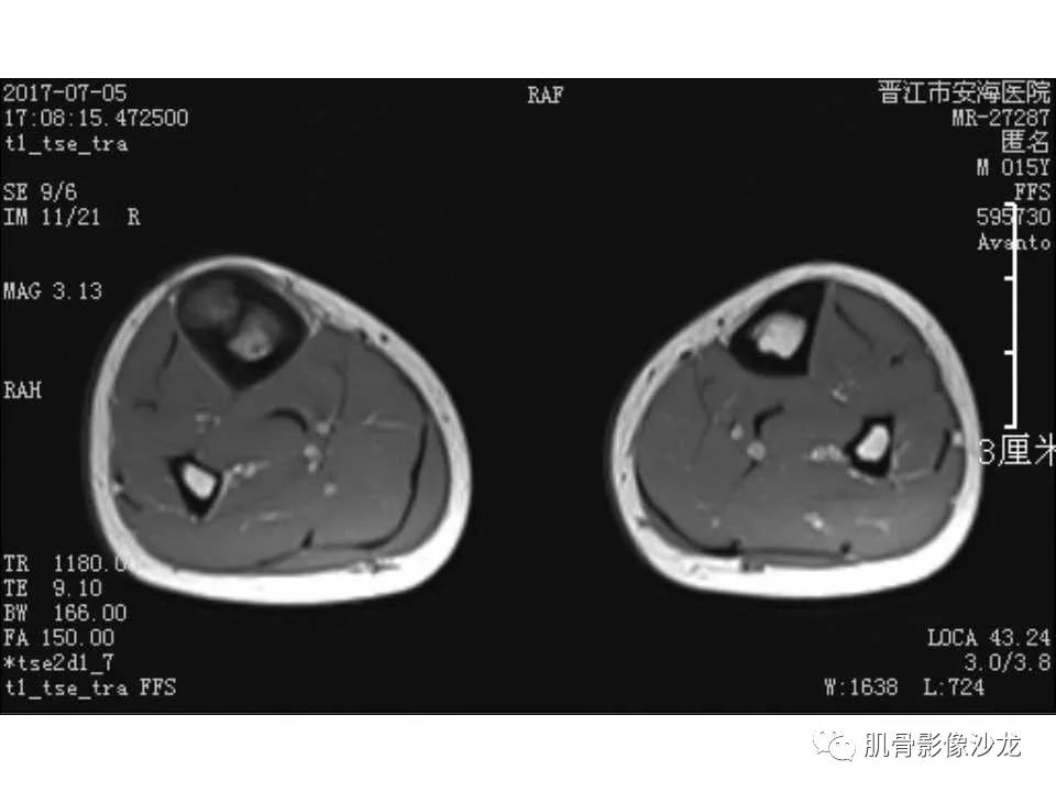 【病例】胫骨骨性纤维结构不良/骨化性纤维瘤1例X线CT及MR 【病例】胫骨骨性纤维结构不良/骨化性纤维瘤1例X线CT及MR