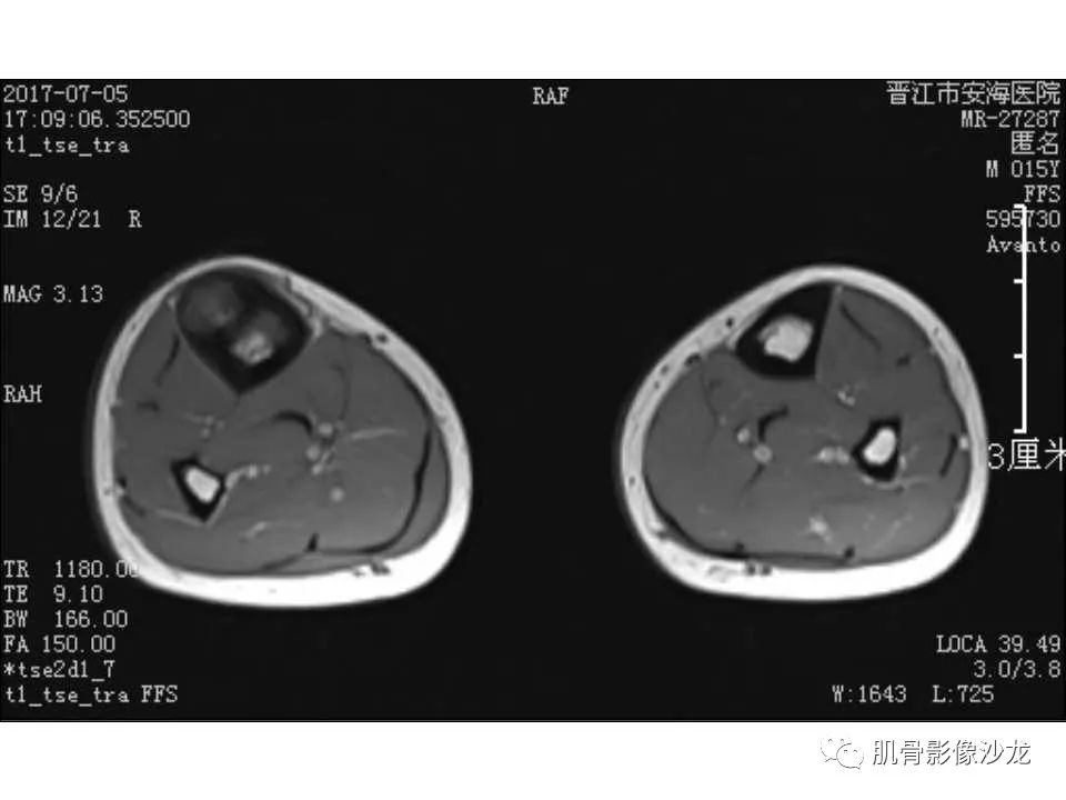 【病例】胫骨骨性纤维结构不良/骨化性纤维瘤1例X线CT及MR 【病例】胫骨骨性纤维结构不良/骨化性纤维瘤1例X线CT及MR