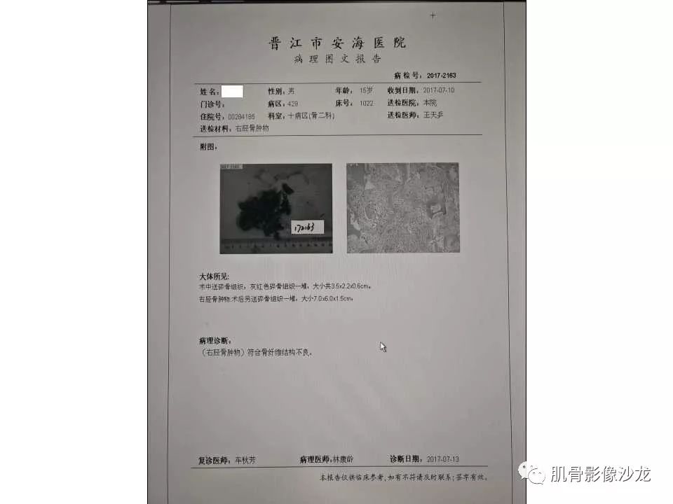 【病例】胫骨骨性纤维结构不良/骨化性纤维瘤1例X线CT及MR 【病例】胫骨骨性纤维结构不良/骨化性纤维瘤1例X线CT及MR