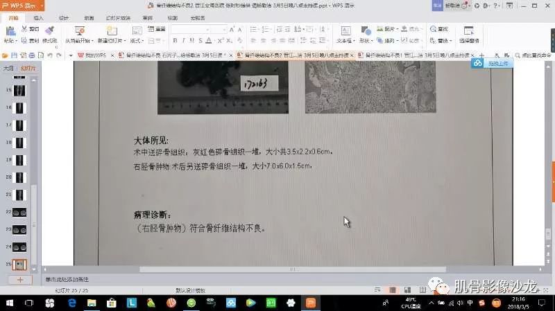 【病例】胫骨骨性纤维结构不良/骨化性纤维瘤1例X线CT及MR 【病例】胫骨骨性纤维结构不良/骨化性纤维瘤1例X线CT及MR