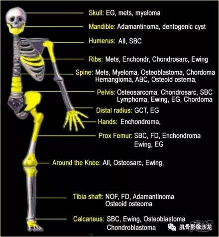 【病例】胫骨骨性纤维结构不良/骨化性纤维瘤1例X线CT及MR 【病例】胫骨骨性纤维结构不良/骨化性纤维瘤1例X线CT及MR