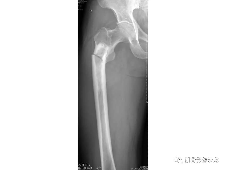 【病例】股骨骨纤维结构不良/骨纤维异常增殖症1例X线MR影像表现