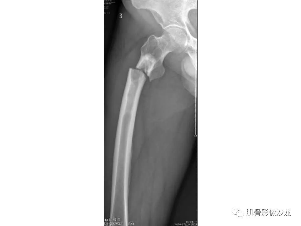【病例】股骨骨纤维结构不良/骨纤维异常增殖症1例X线MR影像表现 【病例】股骨骨纤维结构不良/骨纤维异常增殖症1例X线MR影像表现