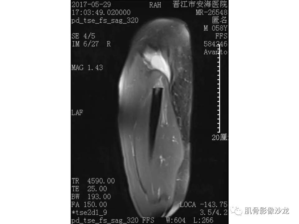 【病例】股骨骨纤维结构不良/骨纤维异常增殖症1例X线MR影像表现 【病例】股骨骨纤维结构不良/骨纤维异常增殖症1例X线MR影像表现
