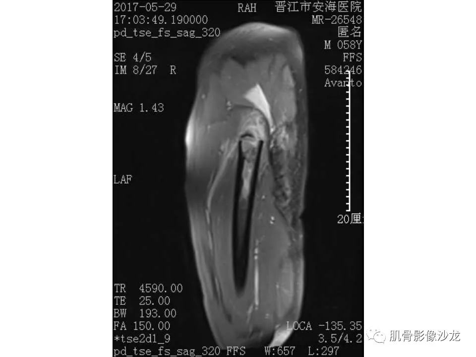【病例】股骨骨纤维结构不良/骨纤维异常增殖症1例X线MR影像表现 【病例】股骨骨纤维结构不良/骨纤维异常增殖症1例X线MR影像表现