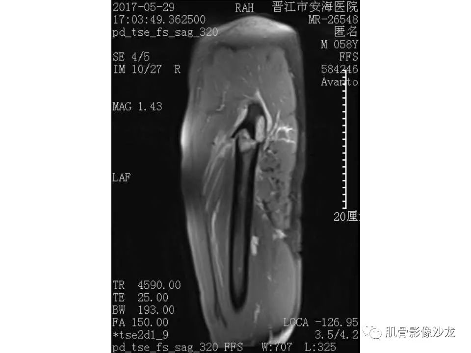 【病例】股骨骨纤维结构不良/骨纤维异常增殖症1例X线MR影像表现 【病例】股骨骨纤维结构不良/骨纤维异常增殖症1例X线MR影像表现