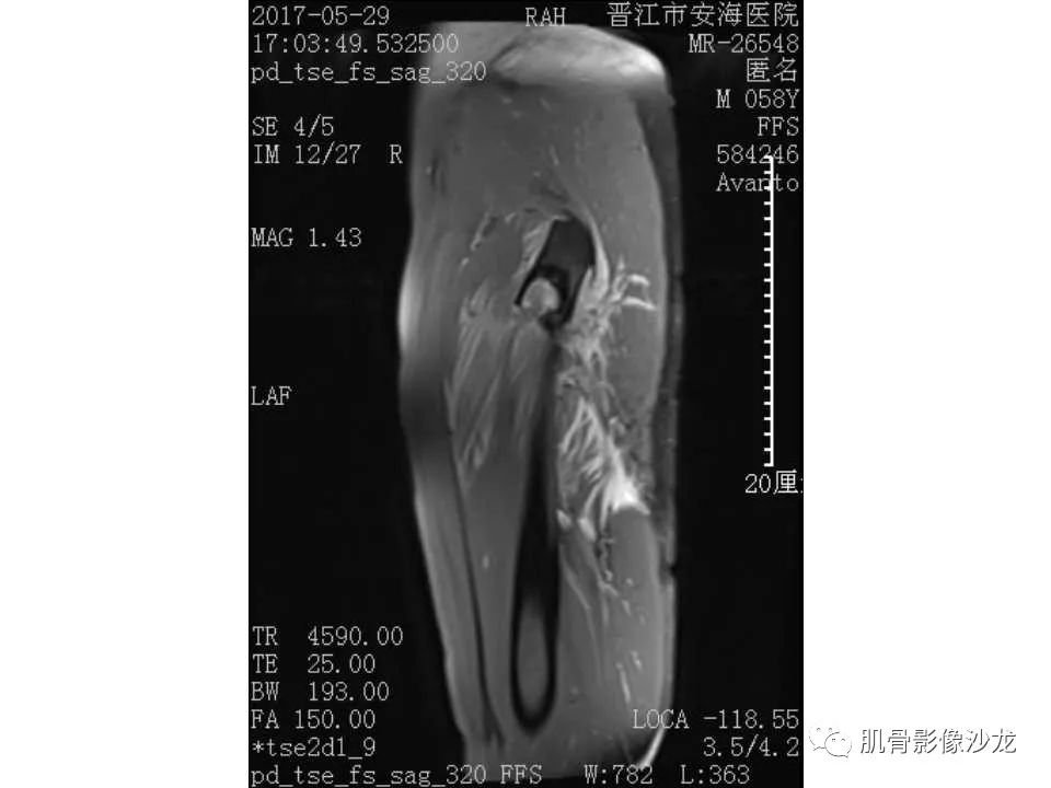 【病例】股骨骨纤维结构不良/骨纤维异常增殖症1例X线MR影像表现 【病例】股骨骨纤维结构不良/骨纤维异常增殖症1例X线MR影像表现