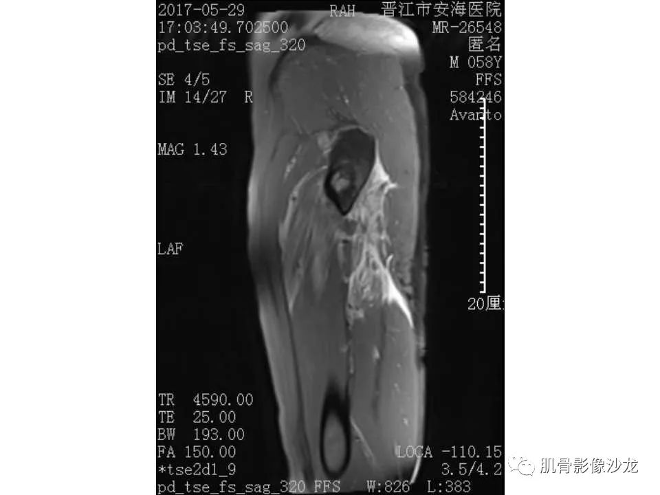 【病例】股骨骨纤维结构不良/骨纤维异常增殖症1例X线MR影像表现 【病例】股骨骨纤维结构不良/骨纤维异常增殖症1例X线MR影像表现