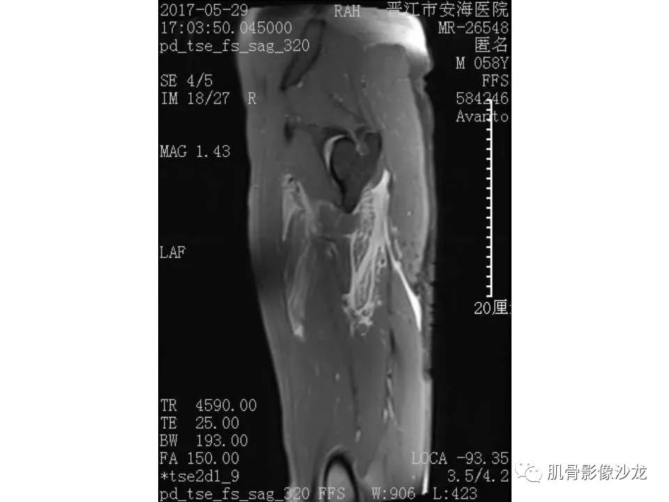 【病例】股骨骨纤维结构不良/骨纤维异常增殖症1例X线MR影像表现 【病例】股骨骨纤维结构不良/骨纤维异常增殖症1例X线MR影像表现