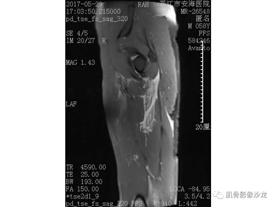 【病例】股骨骨纤维结构不良/骨纤维异常增殖症1例X线MR影像表现 【病例】股骨骨纤维结构不良/骨纤维异常增殖症1例X线MR影像表现