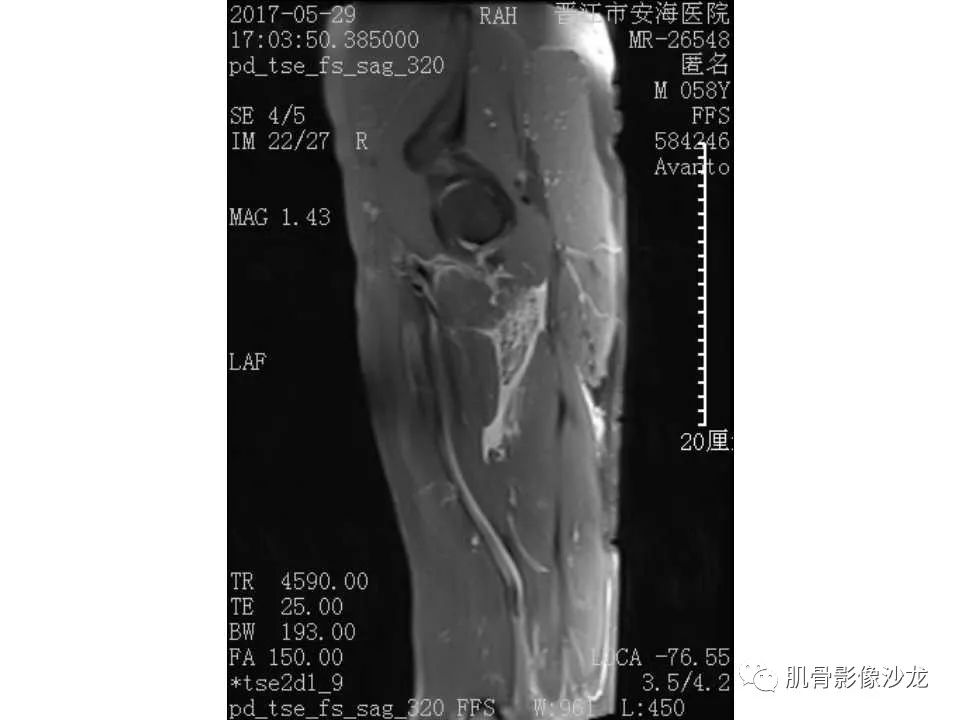 【病例】股骨骨纤维结构不良/骨纤维异常增殖症1例X线MR影像表现 【病例】股骨骨纤维结构不良/骨纤维异常增殖症1例X线MR影像表现