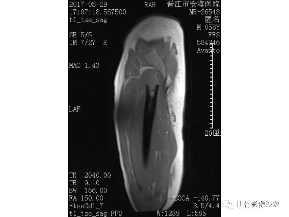 【病例】股骨骨纤维结构不良/骨纤维异常增殖症1例X线MR影像表现 【病例】股骨骨纤维结构不良/骨纤维异常增殖症1例X线MR影像表现