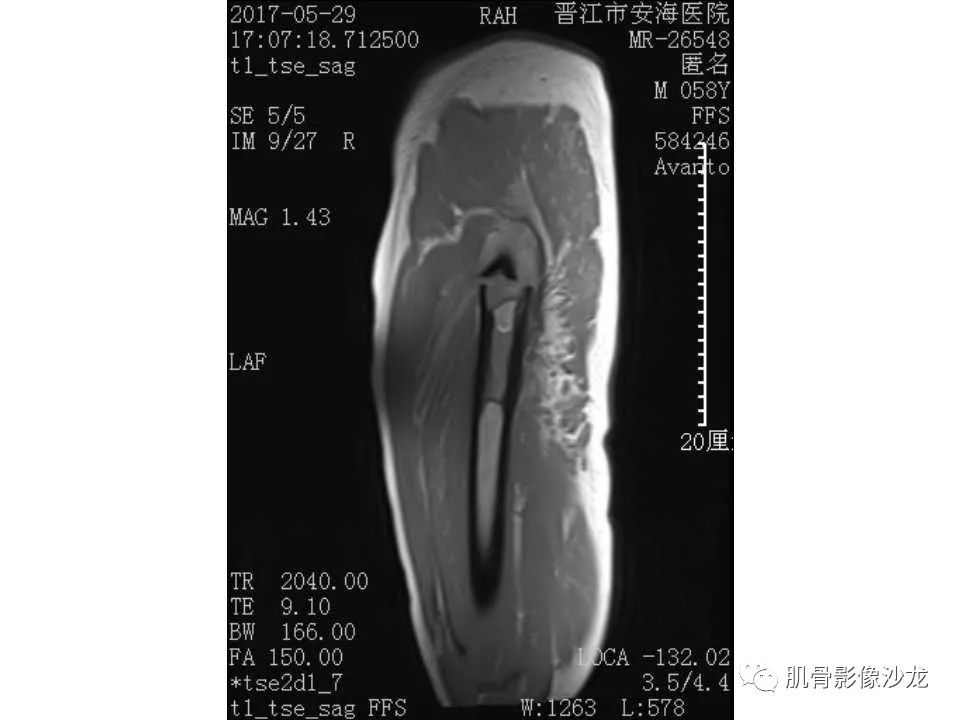 【病例】股骨骨纤维结构不良/骨纤维异常增殖症1例X线MR影像表现 【病例】股骨骨纤维结构不良/骨纤维异常增殖症1例X线MR影像表现