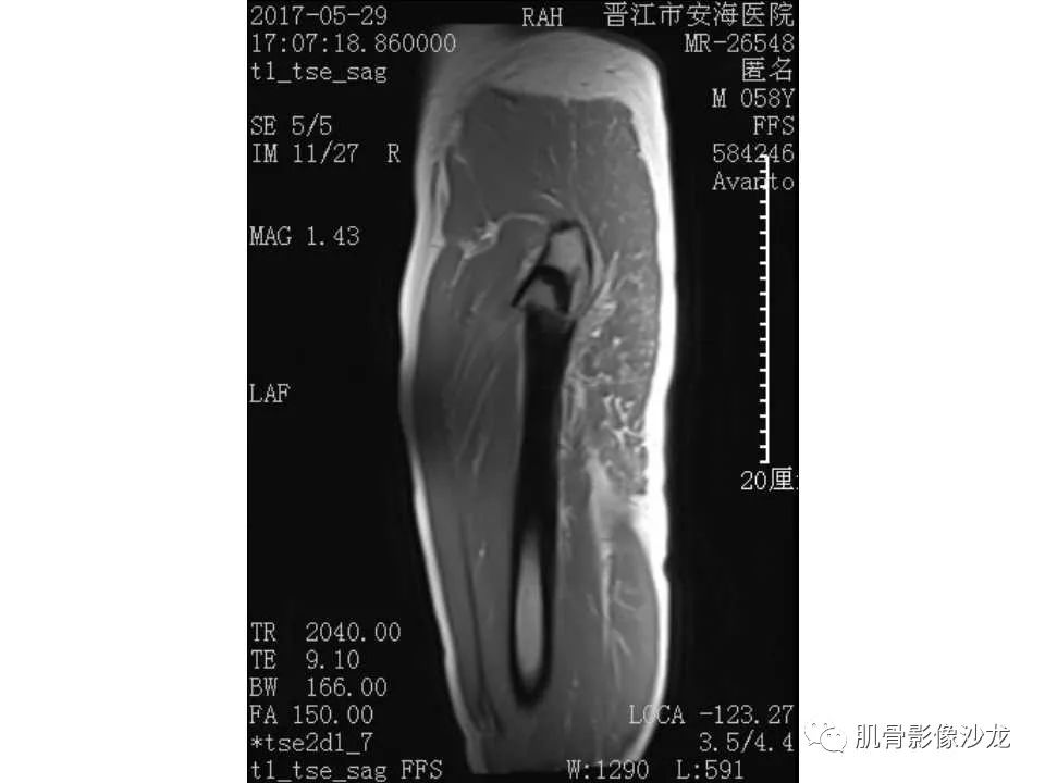 【病例】股骨骨纤维结构不良/骨纤维异常增殖症1例X线MR影像表现 【病例】股骨骨纤维结构不良/骨纤维异常增殖症1例X线MR影像表现