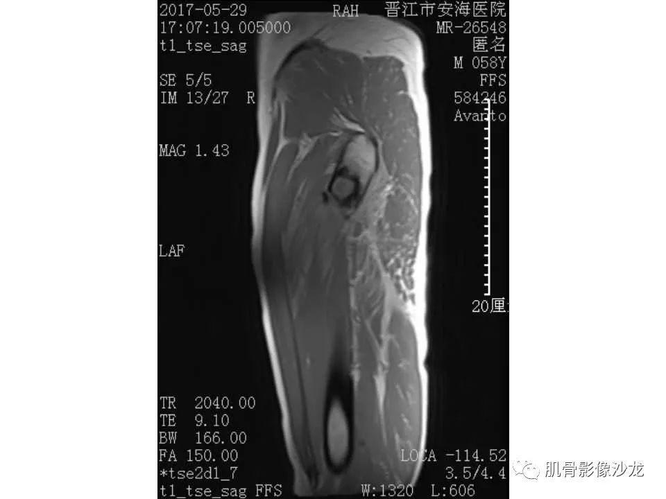 【病例】股骨骨纤维结构不良/骨纤维异常增殖症1例X线MR影像表现 【病例】股骨骨纤维结构不良/骨纤维异常增殖症1例X线MR影像表现