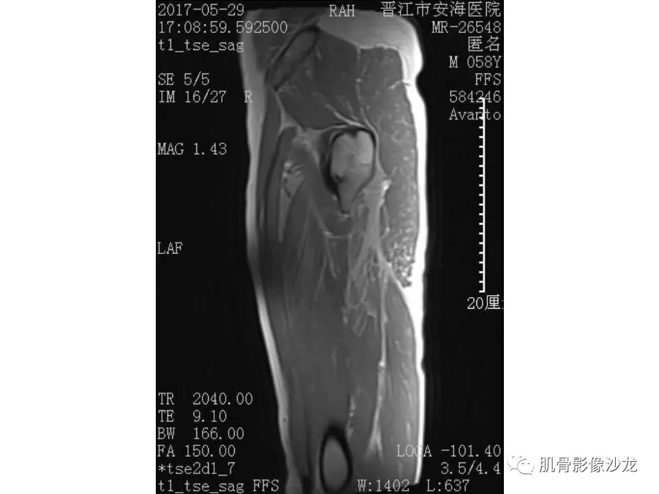 【病例】股骨骨纤维结构不良/骨纤维异常增殖症1例X线MR影像表现 【病例】股骨骨纤维结构不良/骨纤维异常增殖症1例X线MR影像表现
